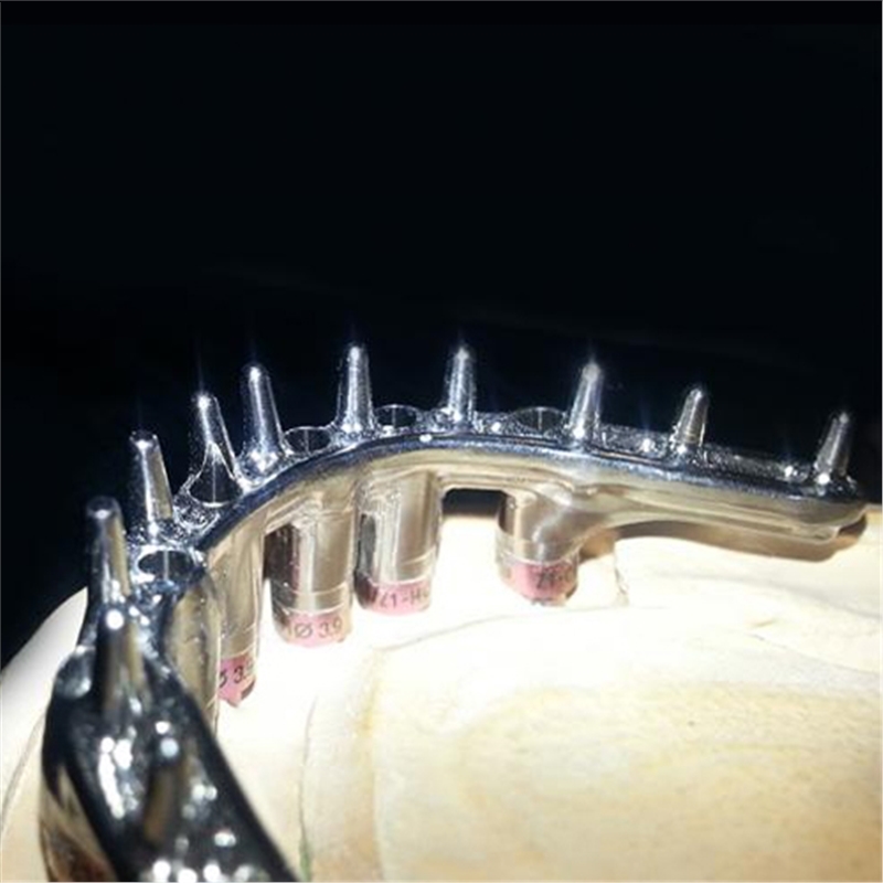 Implant Bars