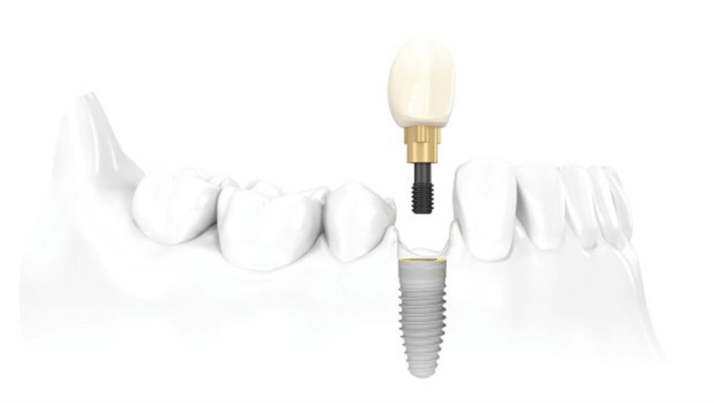 Implant Tedavisinin Avantajları