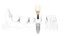 Advantages of Implant Treatment