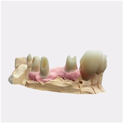 Hybrid Abutment