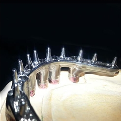 Implant Bars